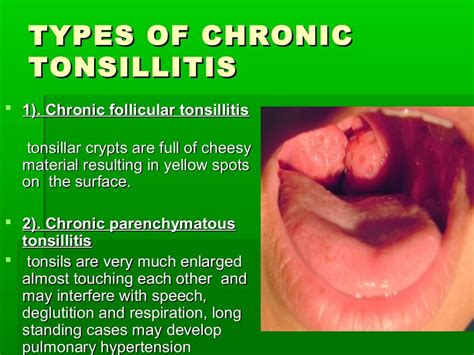 Acute And Chronic Tonsillitis And Their Management