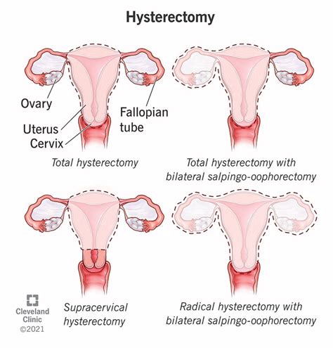 Hysterectomy Purpose Procedure Benefits Risks Recovery