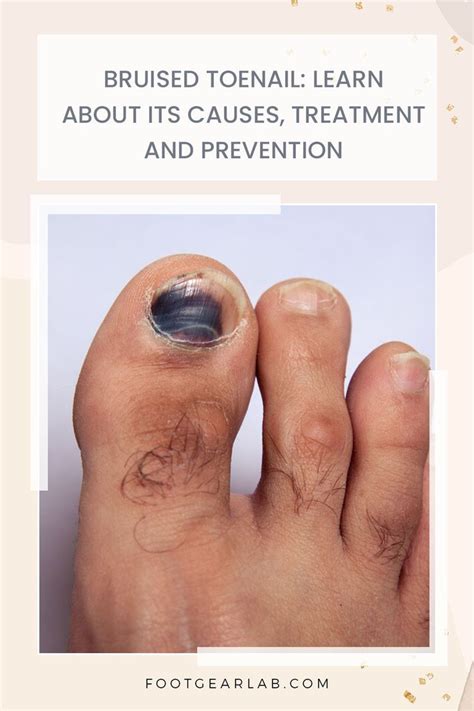 Bruised Toenail Learn About Its Causes Treatment And Prevention Artofit