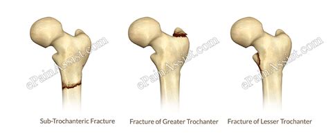 Hip Joint Fractureclassificationtypescausessymptomssignstreatment