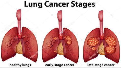 About 13% of all new cancers are lung cancer. DR. FAROOQ KHAN'S ELITE CLINIC: Lung Cancer