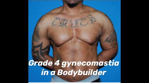 Bodybuilder Gynecomastia Chicago Before And After Gynecomastia