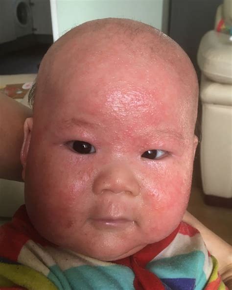 Eczema Treatment Baby Cleared Eczema Rash On Face Using This Cream