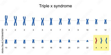 Triple X Syndrome Karyotype Vector Esp10 Stock Vector Adobe Stock