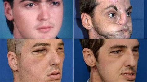 El Hombre Con El Primer Transplante De Cara Ahora Es Portada De Revista Fotos