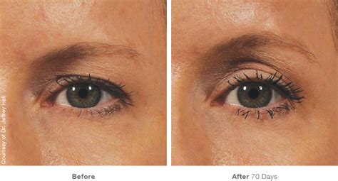 How Does Surgery Free Skin Tightening Work Radiance Medspa Wheaton
