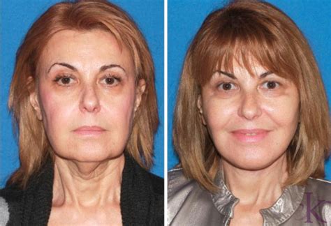 Facelift Case 41 Dr Vasyukevich Facial Plastic Surgeon Nyc