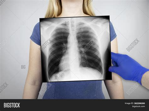 X Ray Chest Woman Image And Photo Free Trial Bigstock