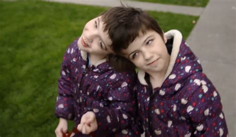 Conjoined Twins Who Share A Brain Hear Each Others Thoughts