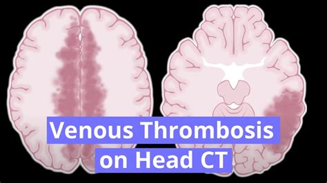 Cerebral Venous Thrombosis Video