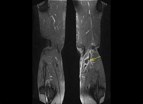 Die thrombose ist ein gefäßverschluss durch ein blutgerinnsel. Tiefe Beinvenenthrombose im MRT | Radiologie Herne Ihre ...