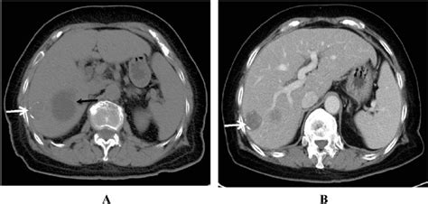 Nodular Subtype Non Enhanced Ct Scan Of The Abdomen Shows A Hypodense