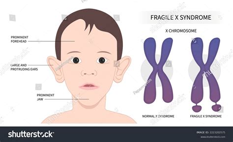 3 Fragile x syndrome face 图片库存照片和矢量图 Shutterstock