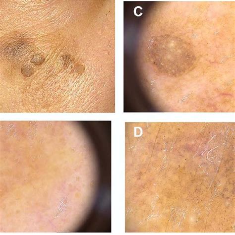 Dermoscopic Features Of Squamous Cell Carcinoma Scc And
