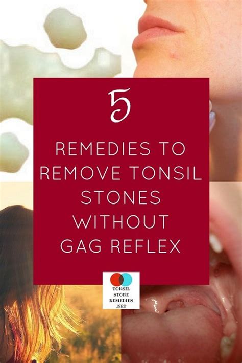 5 Home Remedies That Can Easily Remove Tonsil Stones Without Any Gag