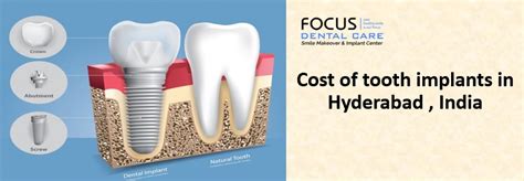 Cost Of Tooth Implants In Hyderabad India Best Dental Implants