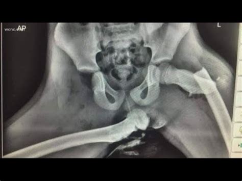 X Ray Image Of Injuries Goes Viral YouTube