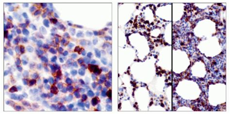 Subcutaneous Panniculitis Like T Cell Lymphoma Basicmedical Key