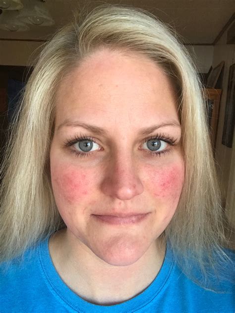 You may have heard that round face shapes should steer clear of bobs, however, that's not entirely true. 11 People Describe What It's Really Like to Have Rosacea ...