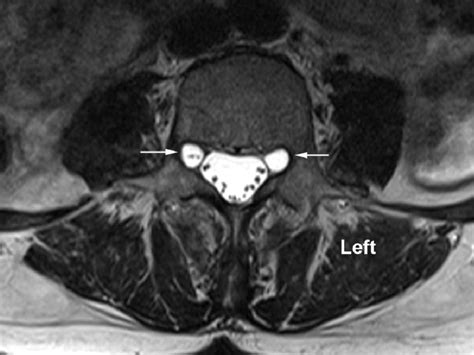 Bilateral Foraminal Tarlov Cysts At L4 5 Level On Axial T2 Weighted