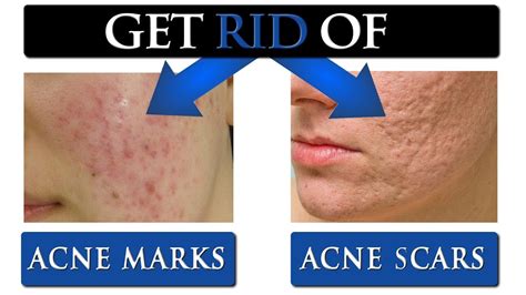 Tips To Get Rid Of Acne Scars Marks On Your Face Youtube