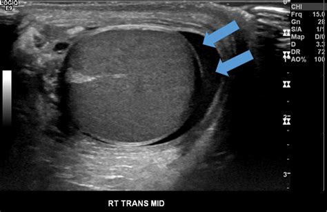 Testicular Appendage Torsion Ultrasound