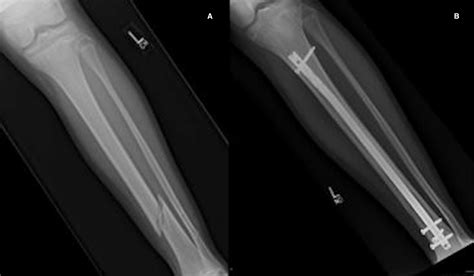 Intramedullary Nailing Of Proximal Tibial Fractures Vrogue Co