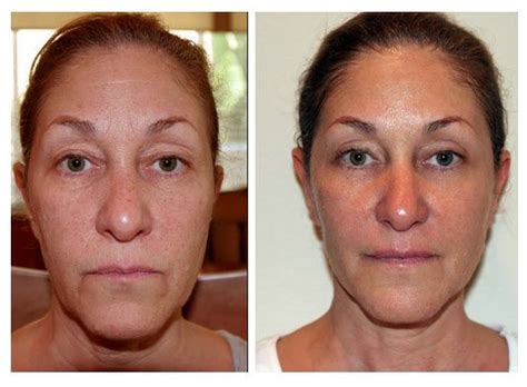 Facial Exercise Before And After Йога для лица Упражнения для лица Лицо