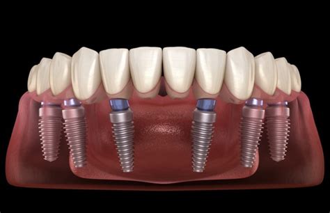 Endosteal Dental Implants Dr Ben Lee