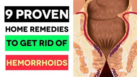 Pin By Balthazarleo On How To Cure Hemorrhoids At Home Fast Getting