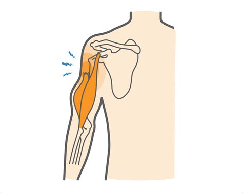 Proximal Biceps Rupture Upswing Health