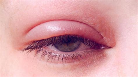 Everything You Need To Know About Lower Swollen Eyelids