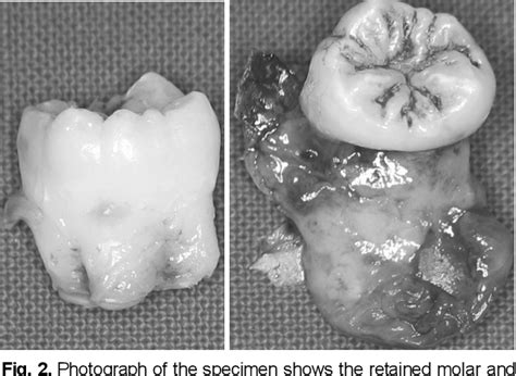 Figure 2 From Bilateral Maxillary Dentigerous Cysts In A Non Syndromic