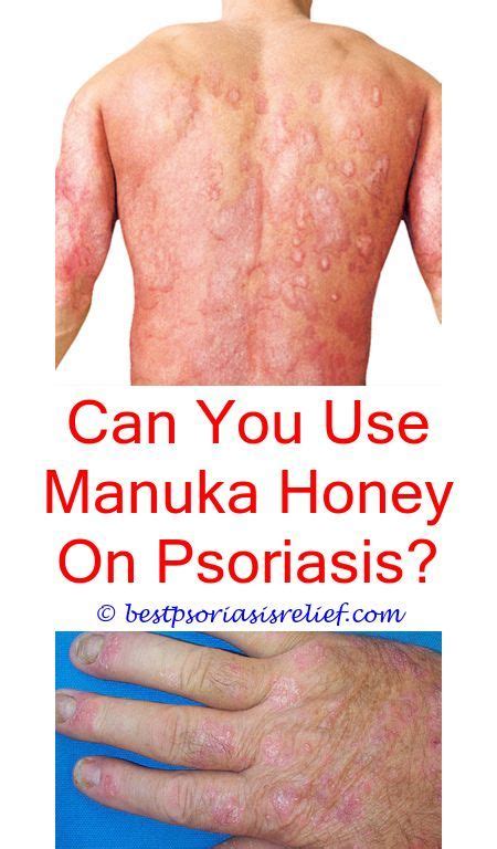 Psoriasisdiet Can Toddlers Have Psoriasis How Do You Contract