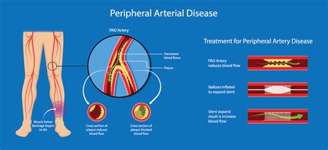 Peripheral Vascular Disease El Paso Tx Imaging And Interventional