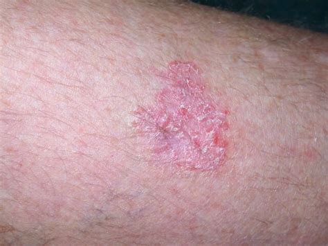 Exquis gril la pollution red spot on leg skin cancer Compétence de Rayé