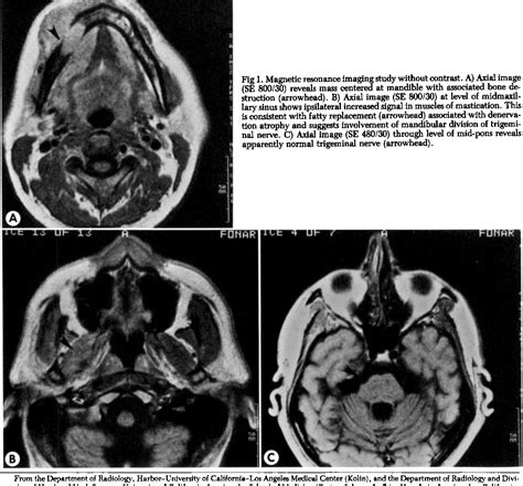 Figure 1 From Perineural Extension Of Squamous Cell Carcinoma