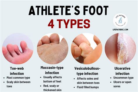 Athletes Foot Pictures Types Symptoms Causes Treatment