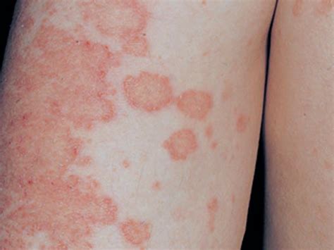 Nummular Dermatitis Symptoms Causes Pictures Treatment Home