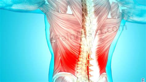 Treatment For Pulled Back Muscle Pain Treat Choices