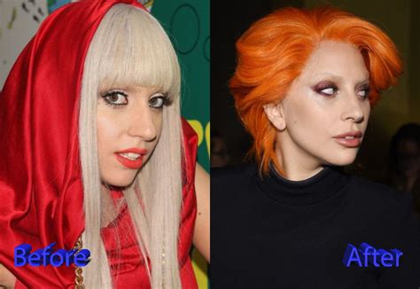 Lady Gaga Nose Job A Multiple Plastic Surgery Procedures