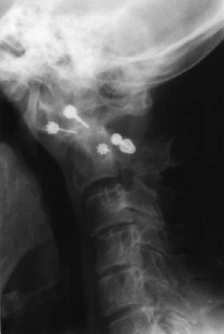A Lateral Plain Radiograph Of The Cervical Spine Acquired In ̄exion