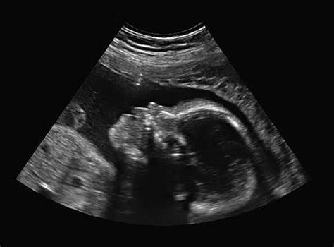 3d4dhd Ultrasound Services Premiere Baby Imaging