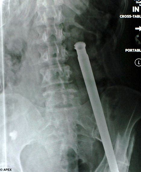 woman impaled by metal spike is saved by her girth daily mail online