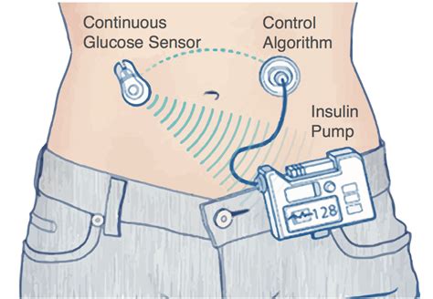 Artificial Pancreas Shows Improved Results But Longer Studies Needed To