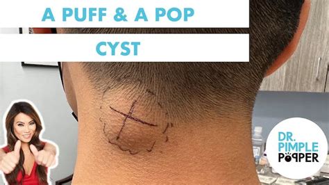 Double Opening Back Cyst Cystactular Cysts Dr Pimple Popper