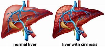 Liver Cirrhosis Bowel Habits Healthy Managing Treating