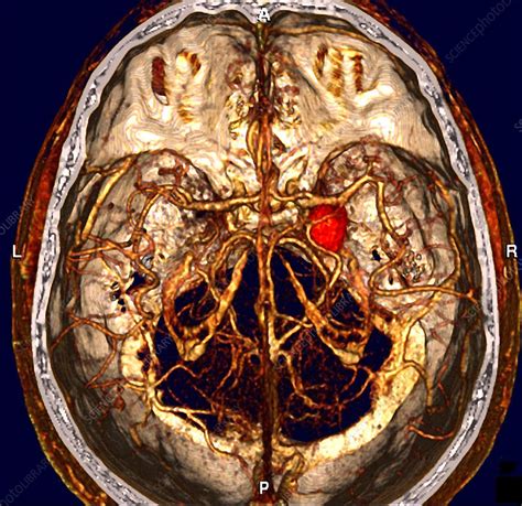 Cerebral Aneurysm Ct Scan Stock Image M1360212 Science Photo