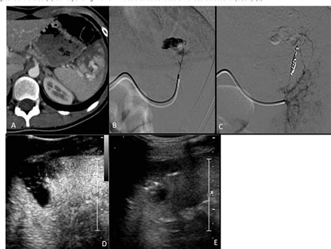 Figure 3 From The Role Of Interventional Radiology In Abdominopelvic