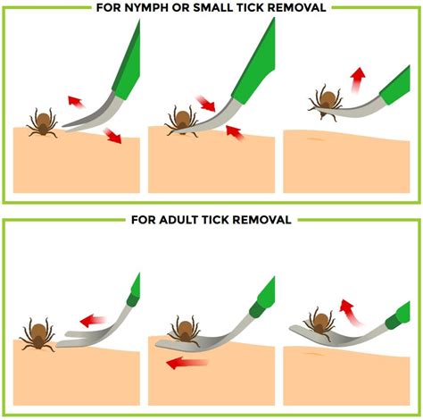 How To Safely Remove A Tick